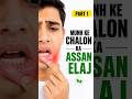 Munh ke chalon ka assan elaj part 1#munhkechaley #healthtips #ytshorts #besthealthvideo