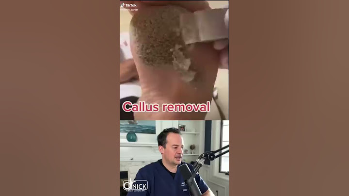 DOCTOR REACTS TO CALLUS REMOVAL! 😱 #shorts #reaction