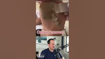 DOCTOR REACTS TO CALLUS REMOVAL! 😱 #shorts #reaction