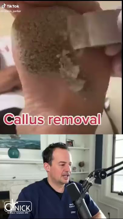 DOCTOR REACTS TO CALLUS REMOVAL! 😱 #shorts #reaction