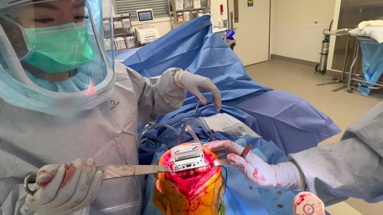 Patient Specific Alignment Simplified with Lantern® Balance