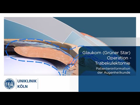 Uniklinik Köln | Augenklinik: Glaukom (Grüner Star) OP - Trabekulektomie (Patienteninformation)