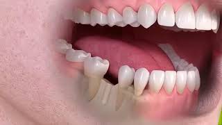 دكتور معتز من عيادات رام الطبية 920020011 تركيبات اسنان احترس قبل التركيبات والزرع تحذيرات خطيرة 360