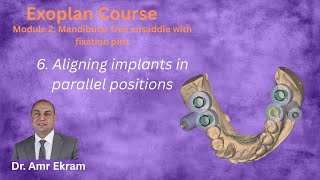 6  Aligning implants in parallel position in Exoplan