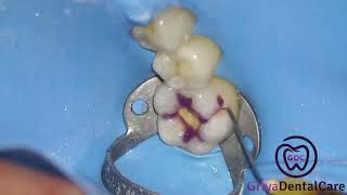 Replacing Amalgam   Direct Restoration Class I Composite by Dr Griya Ridha