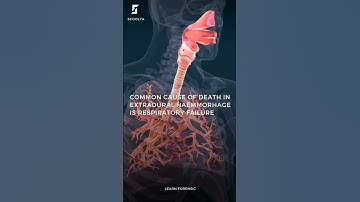 Forensic Science  Facts - Part 2 | Extradural Haemorrhage case #forensic #shorts