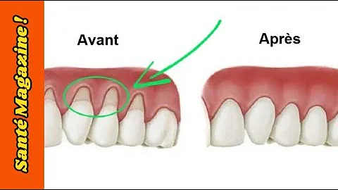 Comment soigner la gencive qui se rétracte