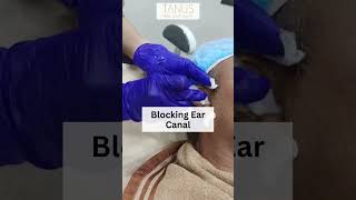 LASER EAR HAIR REDUCTION