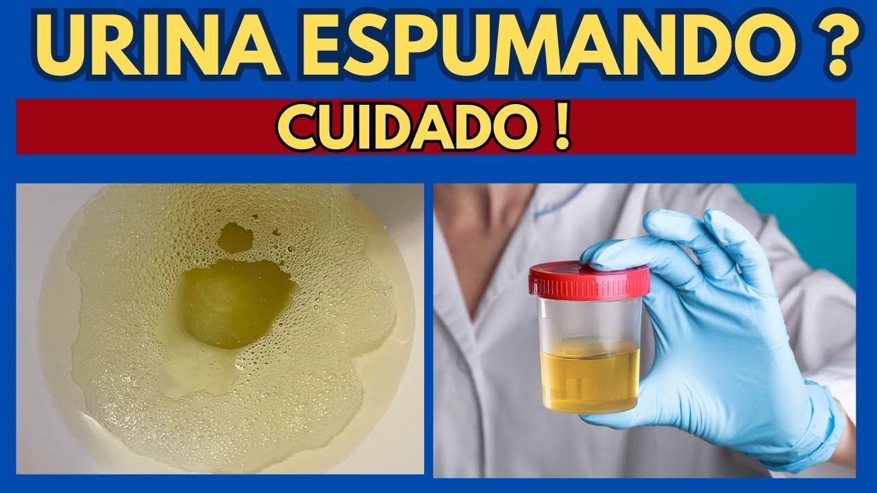 URINA ESPUMANDO MUITO ! o que pode ser ? como tratar ? ( PROTEINÚRA ...
