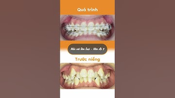 Hành trình LỘT XÁC nhờ niềng răng của Minh Nhật