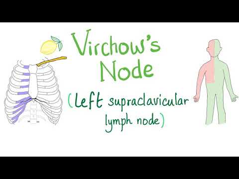 Virchow's Node (Left Supraclavicular Lymph Node)