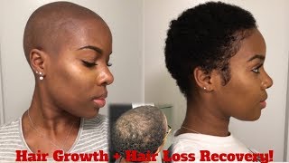 4 Month Update! | Hair Regrowth After HAIR LOSS + Current Hair Care Routine | #GrowWithMe | Nia Hope