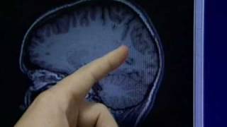 Autism Brain Waves - NJN News Healthwatch Report