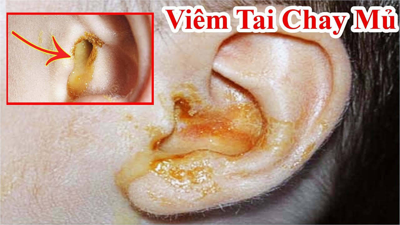 Cách Trị Viêm Tai Chảy Mủ - Viêm Tai Giữa Ngứa Tai - Bài Thuốc Dân Gian ...