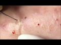 Satisfying blackheads