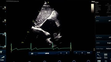 bicaval or  snail view