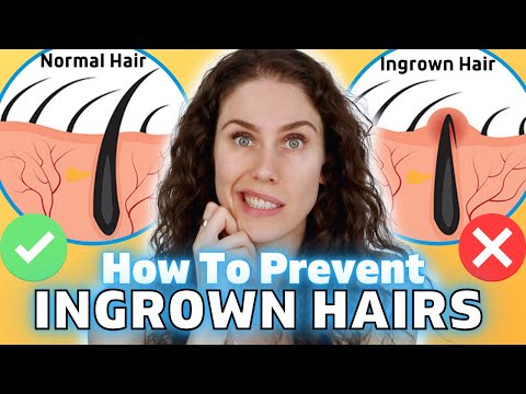 How To Get Rid Of Ingrown Hairs - Advice From A Medical Esthetician