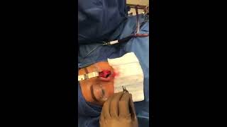 Tipplasty  Rhinoplasty | Dr. David P. Rapaport NYC