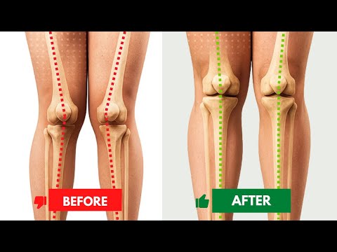 How To Unf*ck Your Knees- Knocked Knees to Straight Knees
