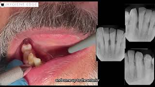 How to check for mobility on a patient with periodontitis by Hygiene Edge 1,978 views 2 months ago 53 seconds