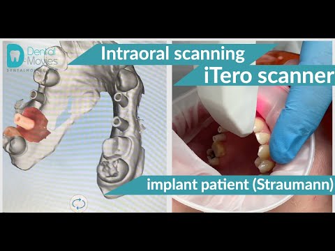 Intraoral scanning using the iTero scanner of an implant patient (Straumann).