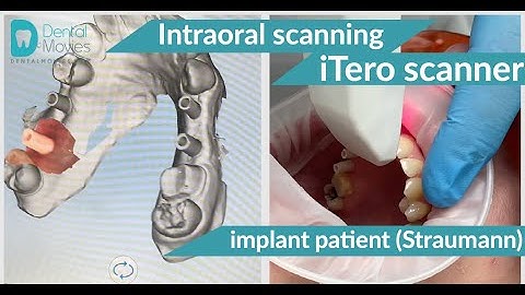 Intraoral scanning using the iTero scanner of an implant patient (Straumann).
