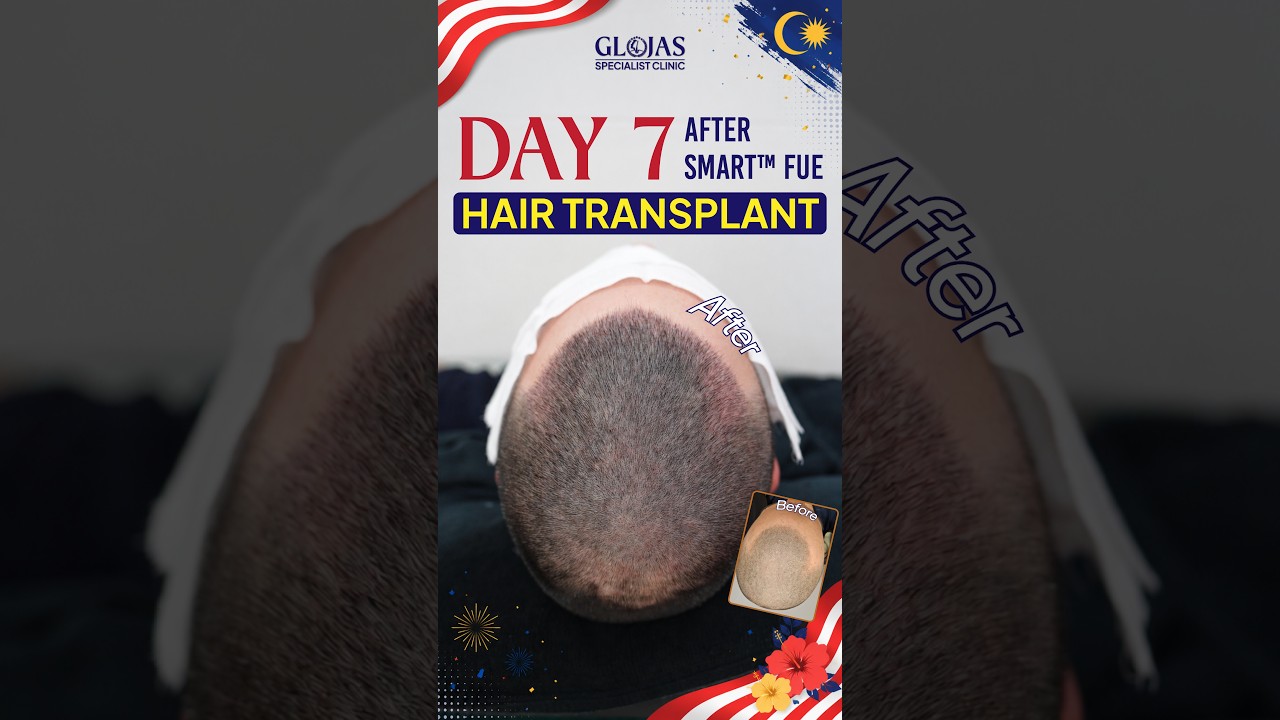 Hair Transplant Malaysia l Day 7 Post-Op: Scalp Healing Well! 🌱 #hairtransplantmalaysia
