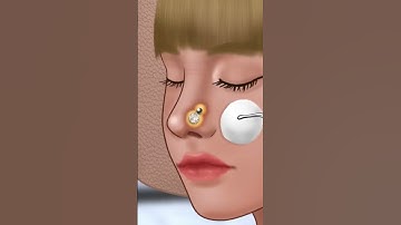 ASMR - 여드름 피부 관리 애니메이션 - Nose Pin 📌 Removal skin care - Spa facial makeup #asmr#shorts#nosetreatment