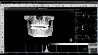 EZ3D PLUS 07 MIP Maximum Intensity Proyection