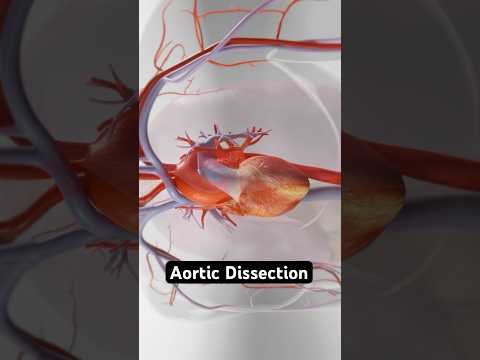 Aortic Dissection: The Chest Pain You Can’t Ignore