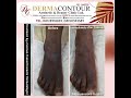 Dark Knuckles Removal using laser by a German Trained Cosmetic Dermatologist in Abuja Nigeria 🇳🇬.