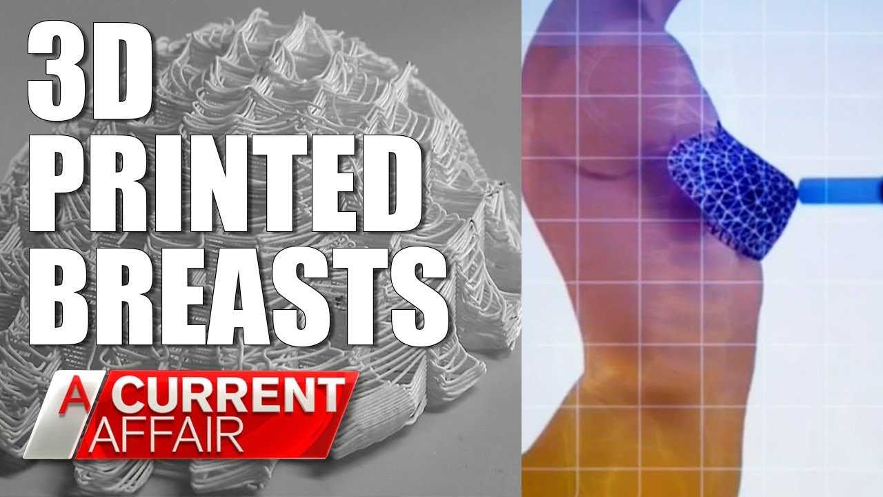 3D Printed Breasts are a game-changer A Current Australia -