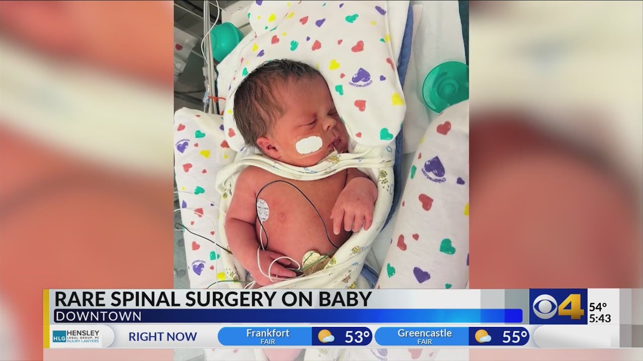 Riley Hospital doctors perform rare spinal surgery on 9-month-old