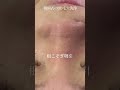 【韓国式3D毛穴洗浄】どれくらい汚れがとれるのか… #毛穴 #毛穴洗浄 #blackheads