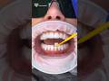 قشور الفينير لا تحتاج لنحت السن كاملا فينير الاسنان Dental Veneers