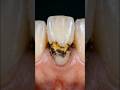 Black cavity teeth 🦷 #teeth #teeth cleaning #teethcare #dental