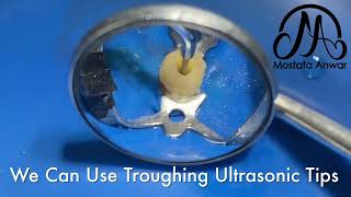 Passive Ultrasonic Irrigation PUI | Irrigation Activation during Root Canal Treatment | Endodontics