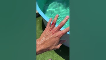 WHEN JAWS ATTACKS YOU!