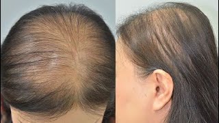 علاج الصلع الورثة وحل مشاكل تسقط الشعر ثلاث وصفات وتنتهى مشكلتك تمام