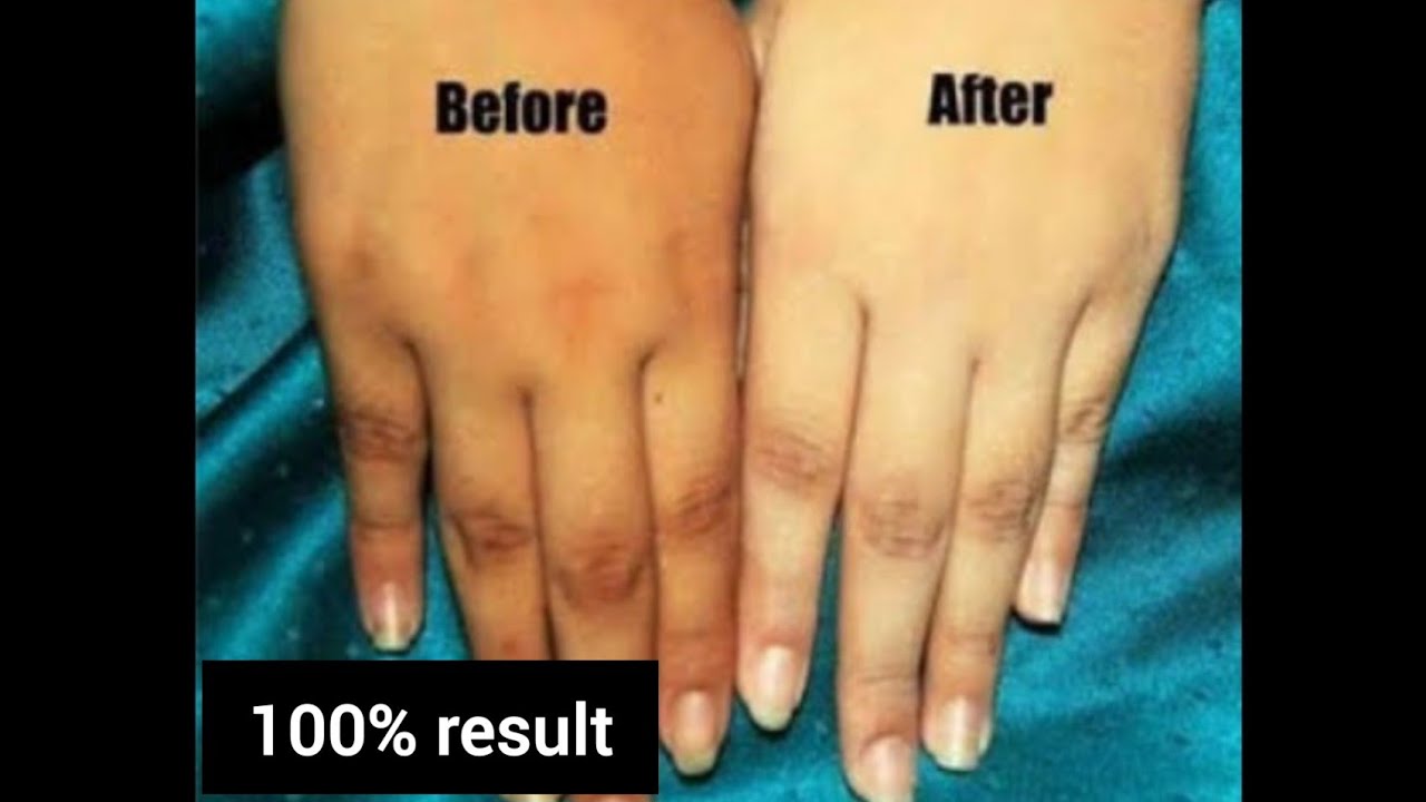 MOST EFFECTIVE SUN TAN REMOVAL HOME REMEDY YouTube