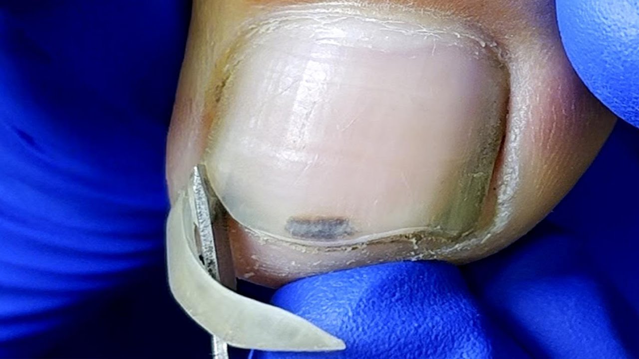 Dirt under your beautiful toenails! Dig clean【Xue Yidao Pedicure】 YouTube