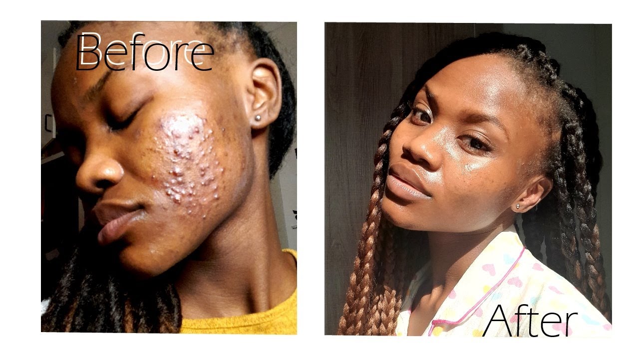How I got rid of my acne in 30 days! - YouTube