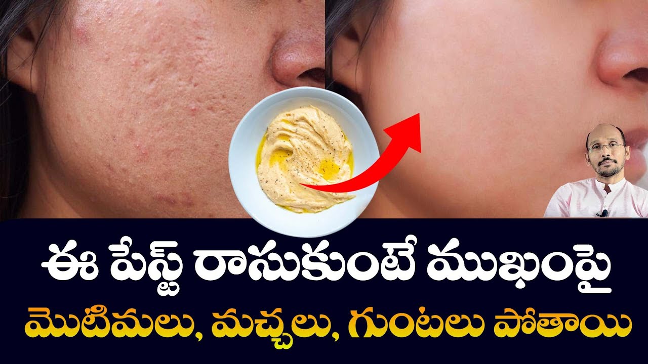 Remove Pimple Marks & Acne Scars Naturally At Home | Dr. Madhu Babu Beauty Tips | Hi Tv Health
