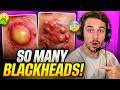Reacting to Extreme CYST & Pimple Popping Videos (SO SATISFYING)