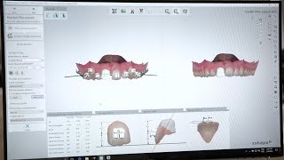 3 reasons to choose 3Shape Indirect Bonding Studio