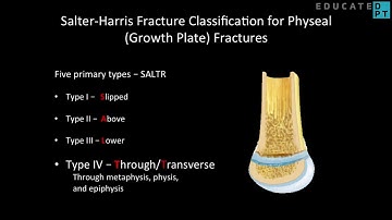 Salter Harris Fracture Classification for Growth Plate Fractures