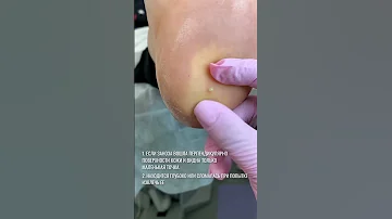 ЗАНОЗА В ПЯТКЕ | MEDPED