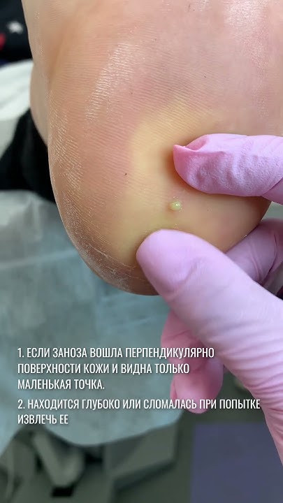 ЗАНОЗА В ПЯТКЕ | MEDPED - YouTube