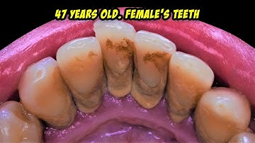 Calculus Removal | Tartar | Scaling | Dentist | Dokter Gigi Tri Putra