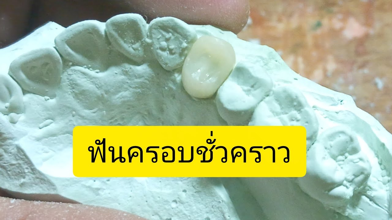 #ฟันครอบชั่วคราว